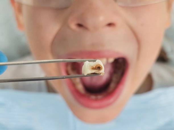 Best Knocked-Out Tooth (Avulsed Tooth) Treatment in Maine, WI